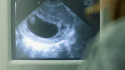 57767_in_ultrasound.